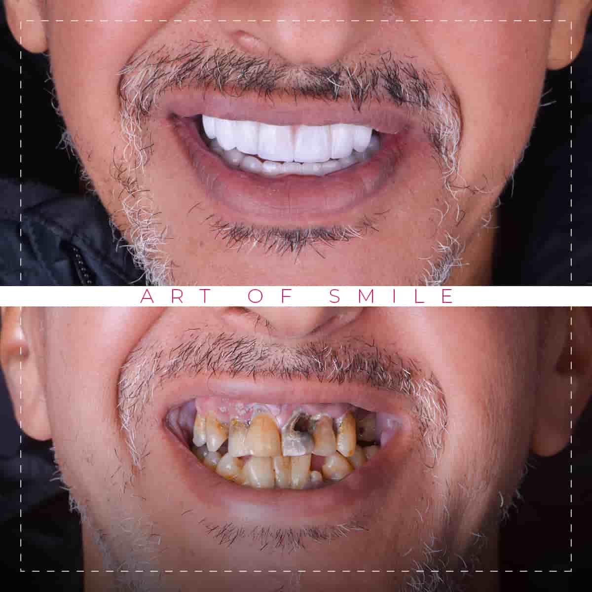 dental clinic in Türkiye Istanbul dental implants Hollywood smile Teeth whitening