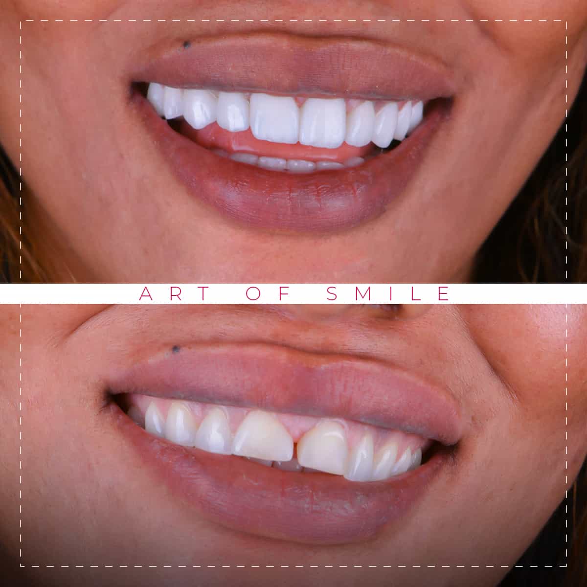 dental clinic in Türkiye Istanbul dental implants Hollywood smile Teeth whitening