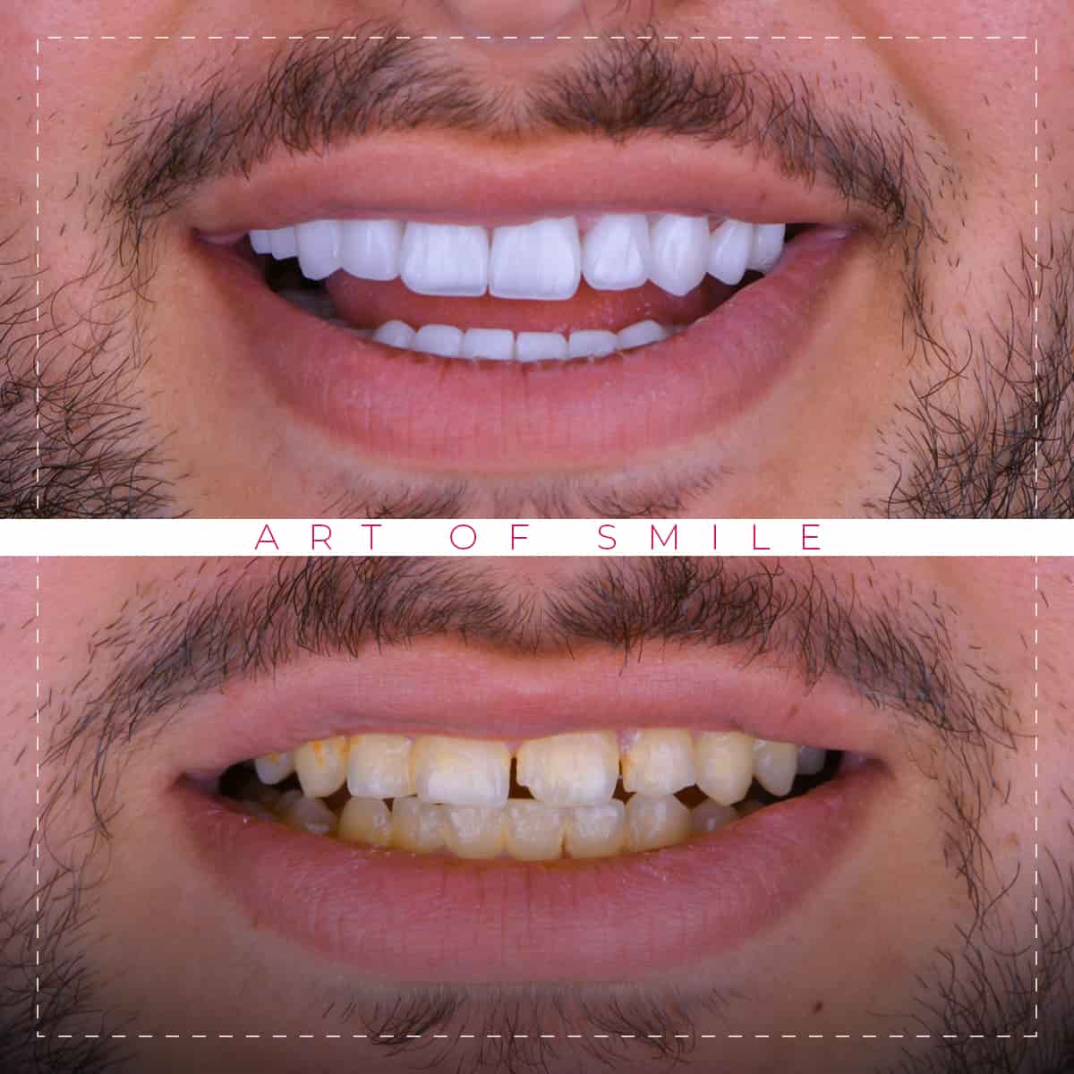 dental clinic in Türkiye Istanbul dental implants Hollywood smile Teeth whitening