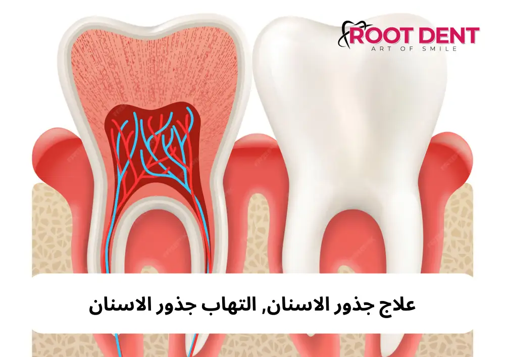 التهاب جذور الاسنان, علاج جذور الأسنان المتعفنة