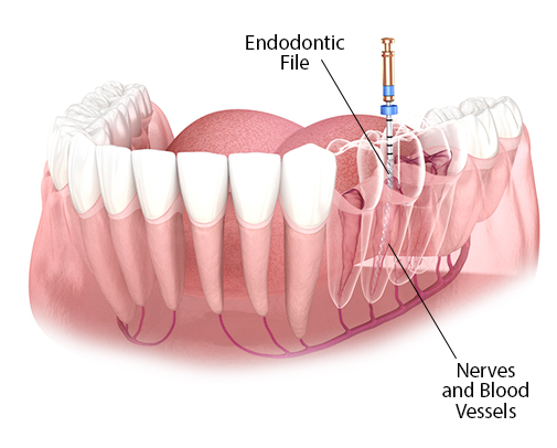 Root Canal Treatment