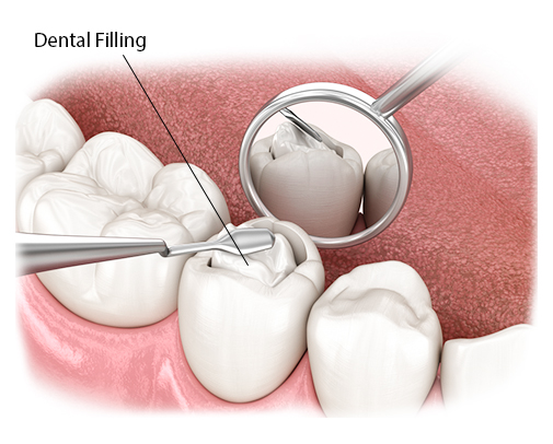 Dental fillings