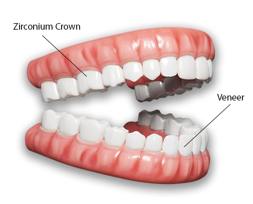 Smile correction