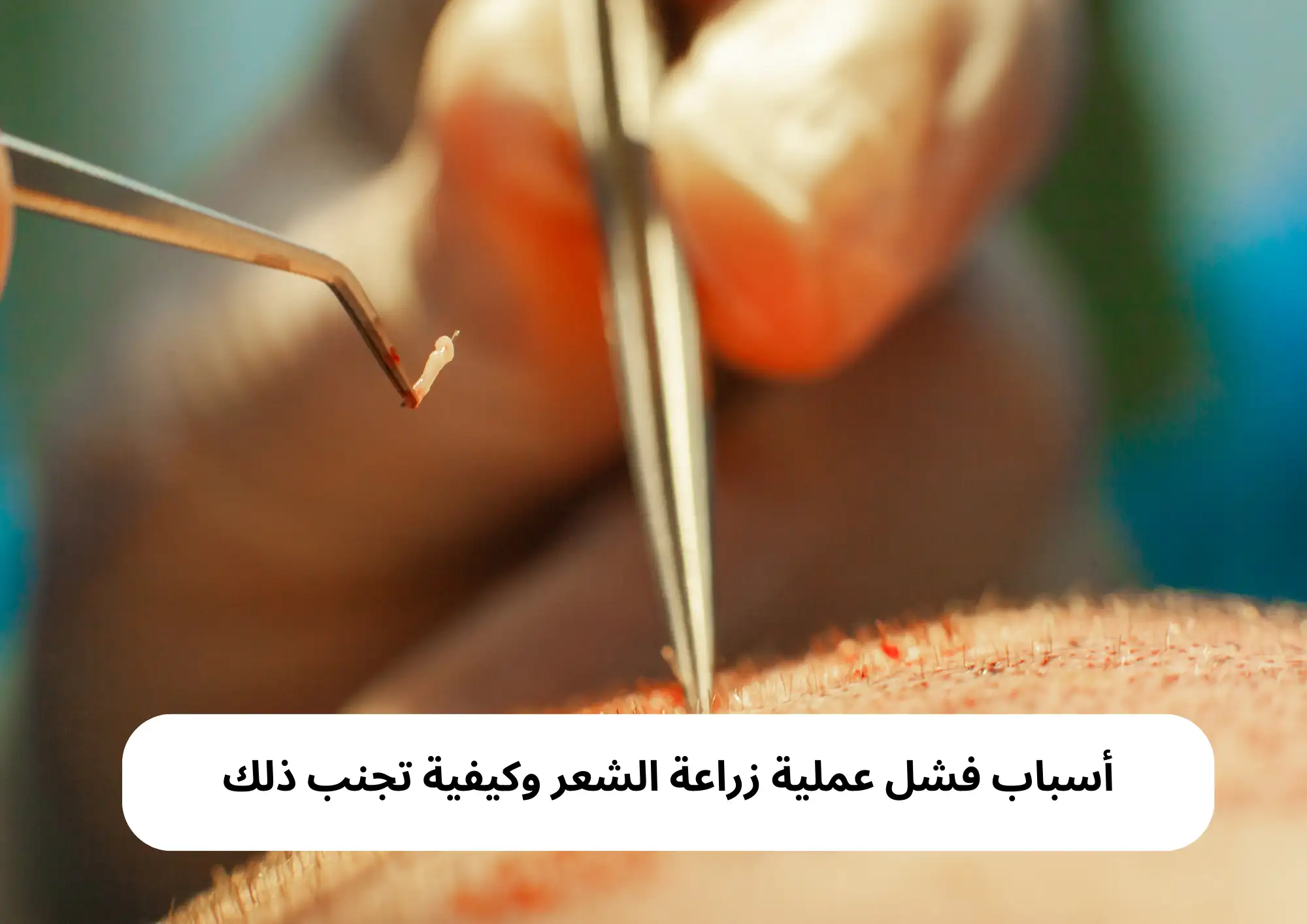 أسباب فشل عملية زراعة الشعر وكيفية تجنب ذلك