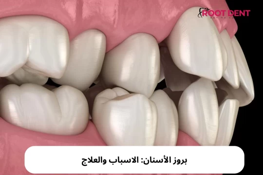 بروز الأسنان: الاسباب والعلاج