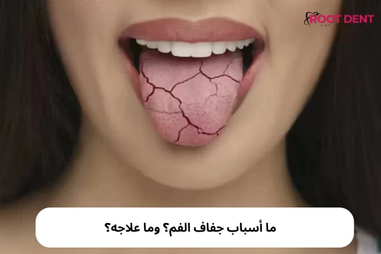 ما أسباب جفاف الفم؟ وما علاجه؟