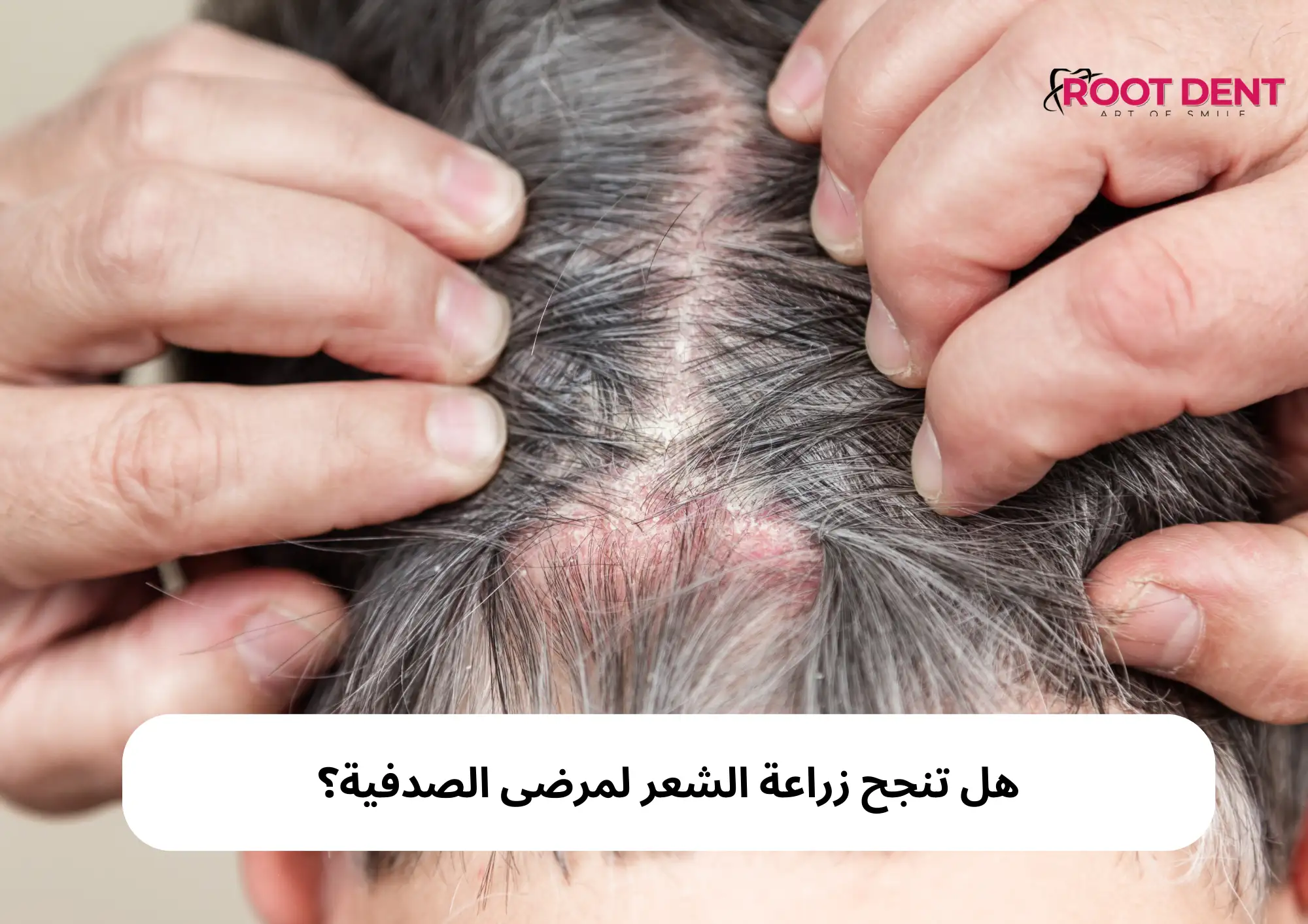 هل تنجح زراعة الشعر لمرضى الصدفية؟