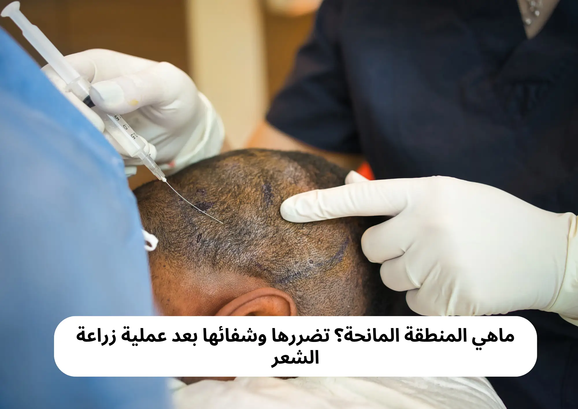 ماهي المنطقة المانحة؟ تضررها وشفائها بعد عملية زراعة الشعر