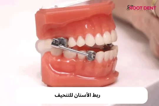 ربط الأسنان للتنحيف