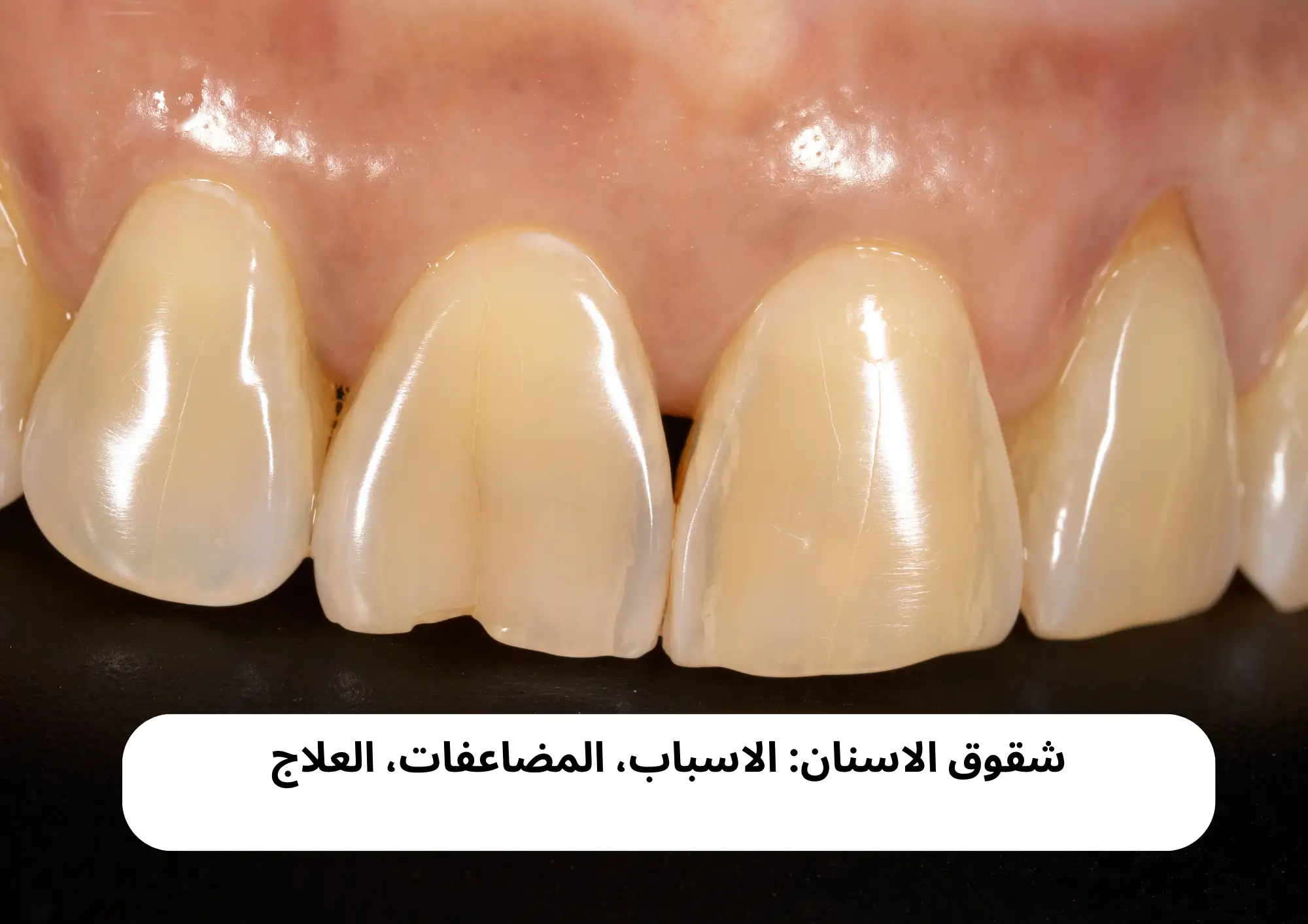 شقوق الاسنان: الاسباب، المضاعفات، العلاج