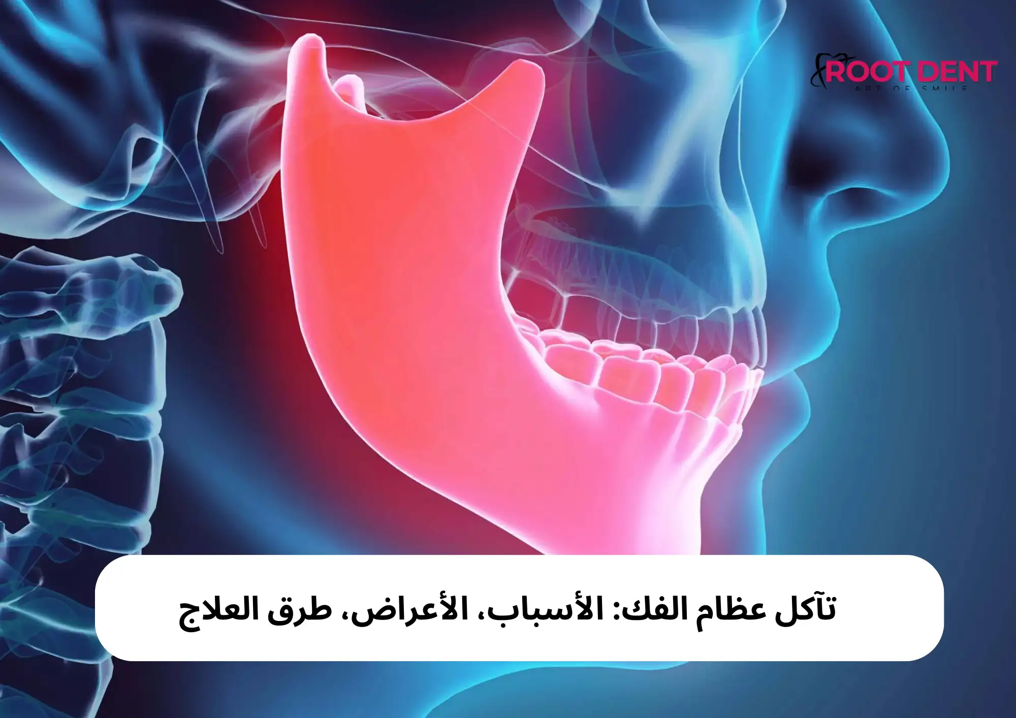 تآكل عظام الفك: الأسباب، الأعراض، طرق العلاج