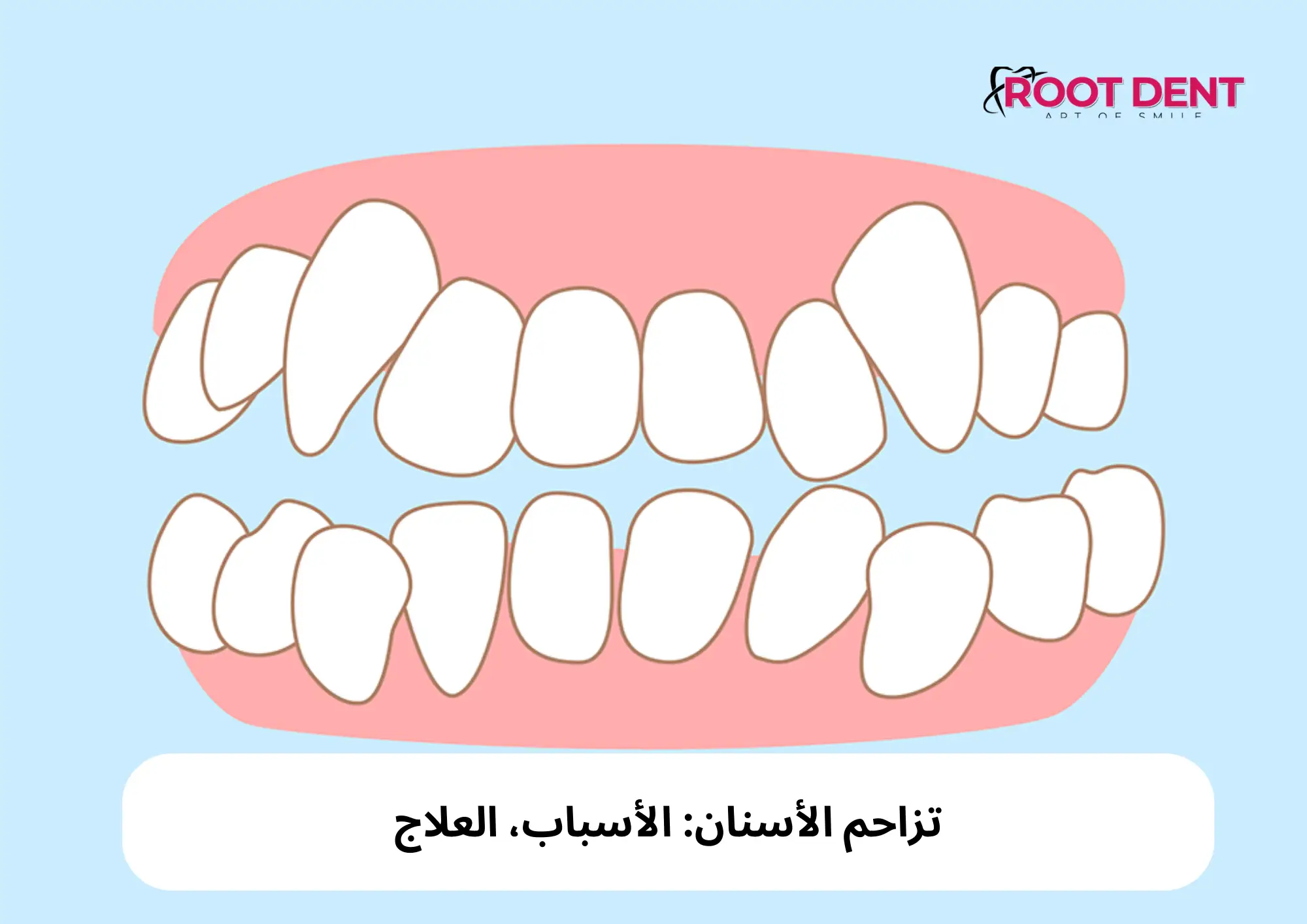 تزاحم الأسنان: الأسباب، العلاج