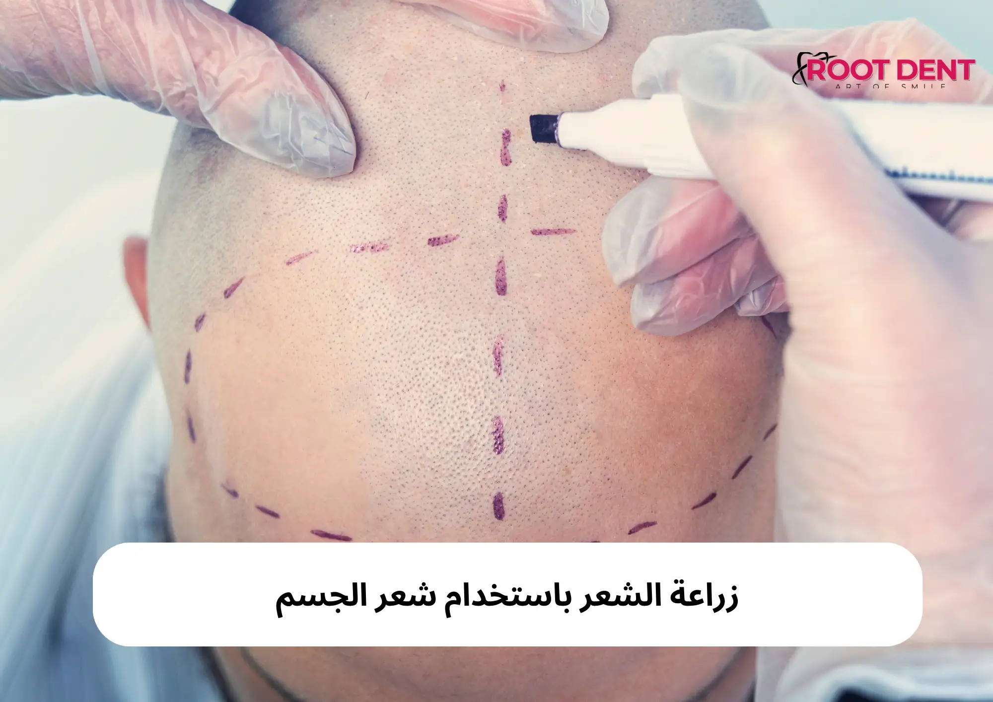 زراعة الشعر باستخدام شعر الجسم