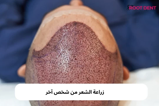 زراعة الشعر من شخص آخر