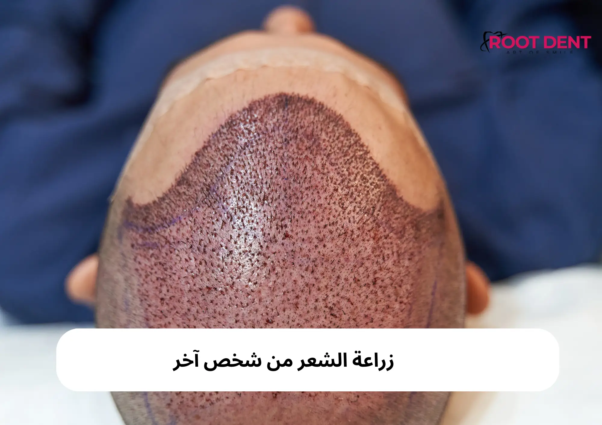 زراعة الشعر من شخص آخر