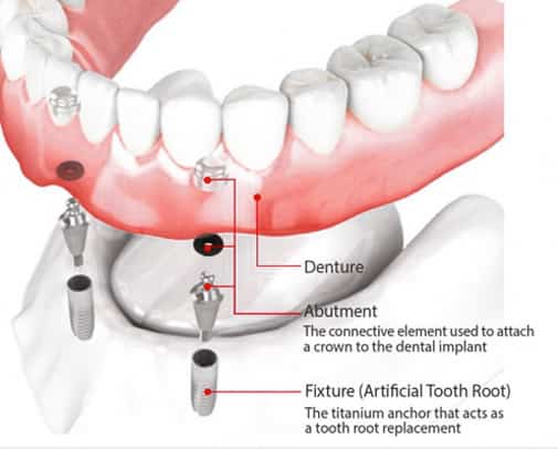 Dental implants