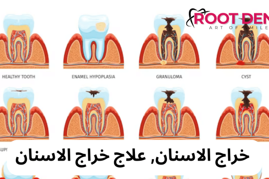 خراج الأسنان بالصور, كيف افقع خراج الأسنان؟ خراج الضرس