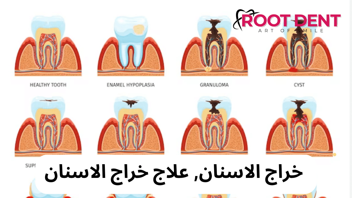 خراج الأسنان بالصور, كيف افقع خراج الأسنان؟ خراج الضرس