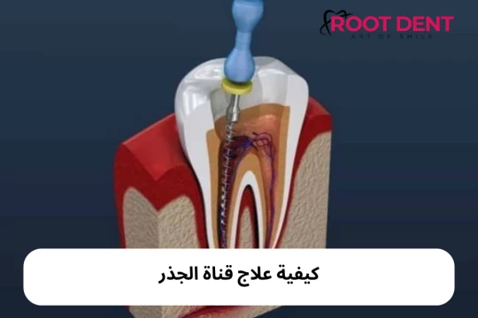 ما هي قناة الجذر؟ كيفية علاج قناة الجذر