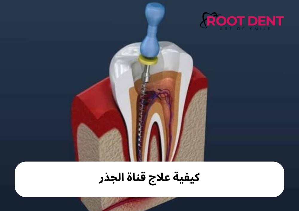 ما هي قناة الجذر؟ كيفية علاج قناة الجذر