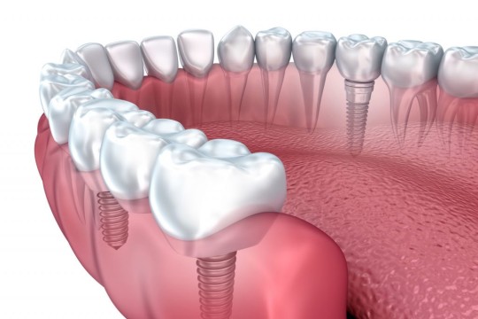 خطوات زراعة الاسنان, ما هي انواع زراعة الاسنان؟ سعر زراعة الاسنان