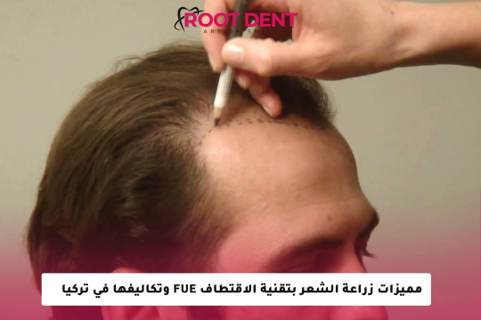 مميزات زراعة الشعر بتقنية الاقتطاف FUE وتكاليفها في تركيا