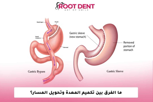 ما الفرق بين تكميم المعدة وتحويل المسار؟