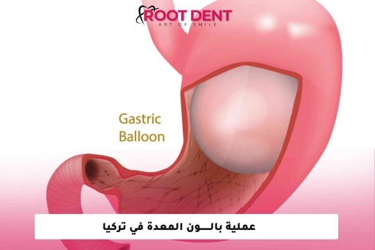 عملية بالون المعدة في تركيا