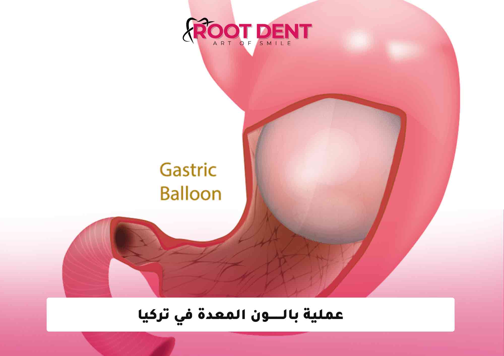 عملية بالون المعدة في تركيا