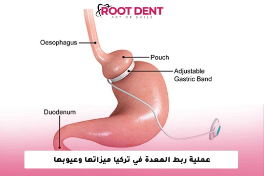 عملية ربط المعدة في تركيا ميزاتها وعيوبها