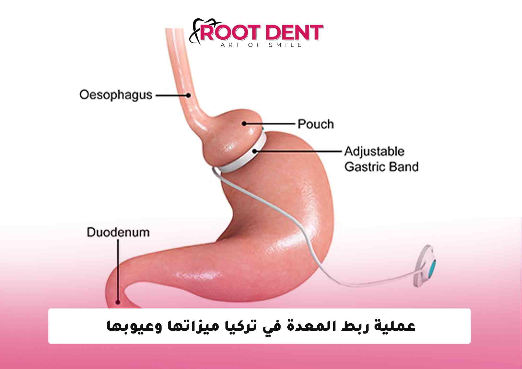 عملية ربط المعدة في تركيا ميزاتها وعيوبها