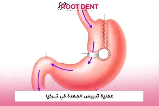 عملية تدبيس المعدة في تركيا