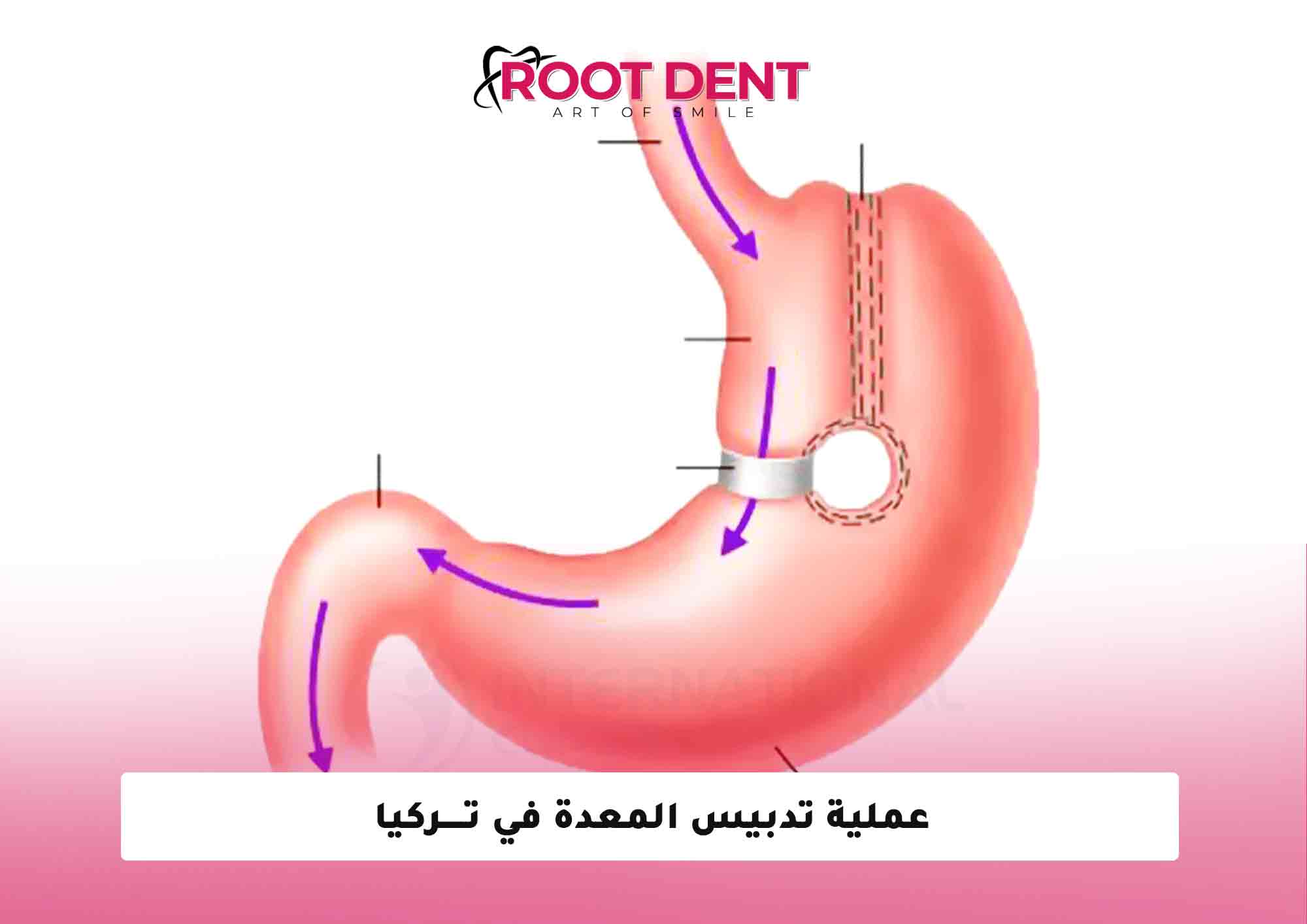 عملية تدبيس المعدة في تركيا