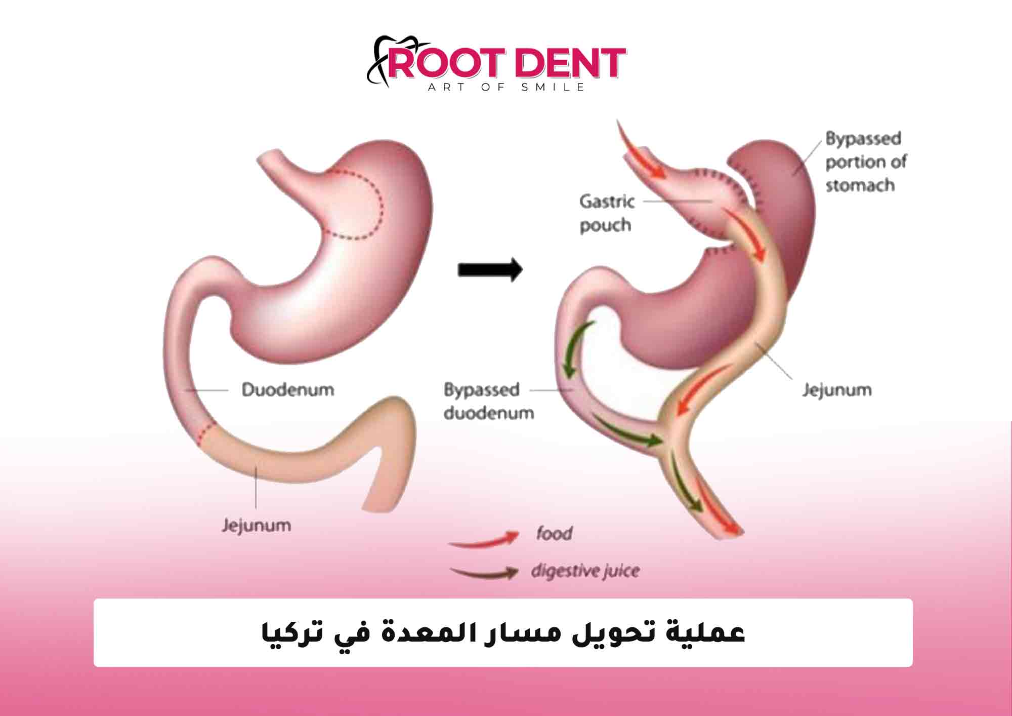 عملية تحويل مسار المعدة في تركيا