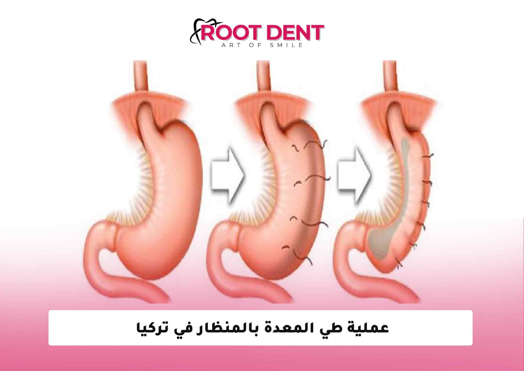 عملية طي المعدة بالمنظار في تركيا