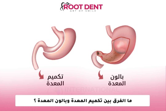 ما الفرق بين تكميم المعدة وبالون المعدة ؟