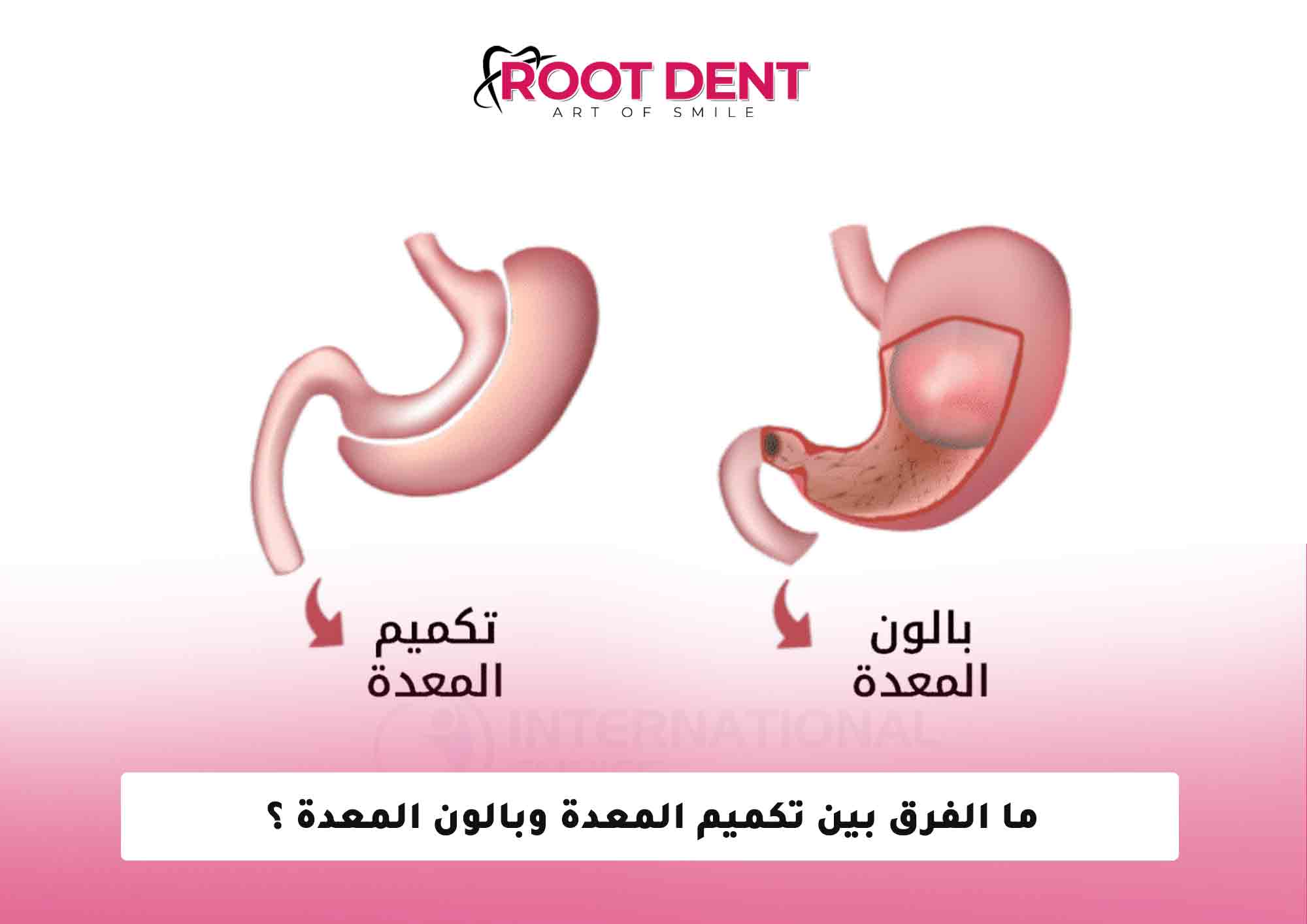 ما الفرق بين تكميم المعدة وبالون المعدة ؟