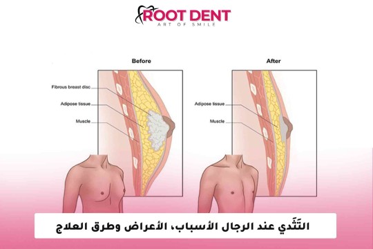 التَثَدي عند الرجال الأسباب، الأعراض وطرق العلاج