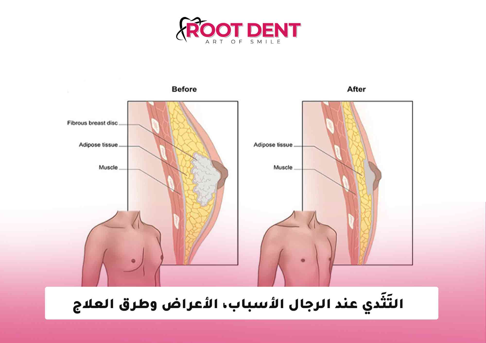 التَثَدي عند الرجال الأسباب، الأعراض وطرق العلاج