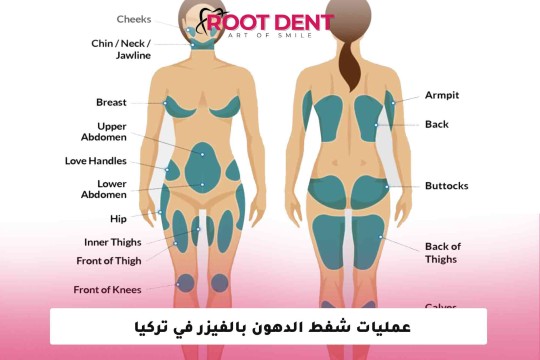 عمليات شفط الدهون بالفيزر في تركيا 2025