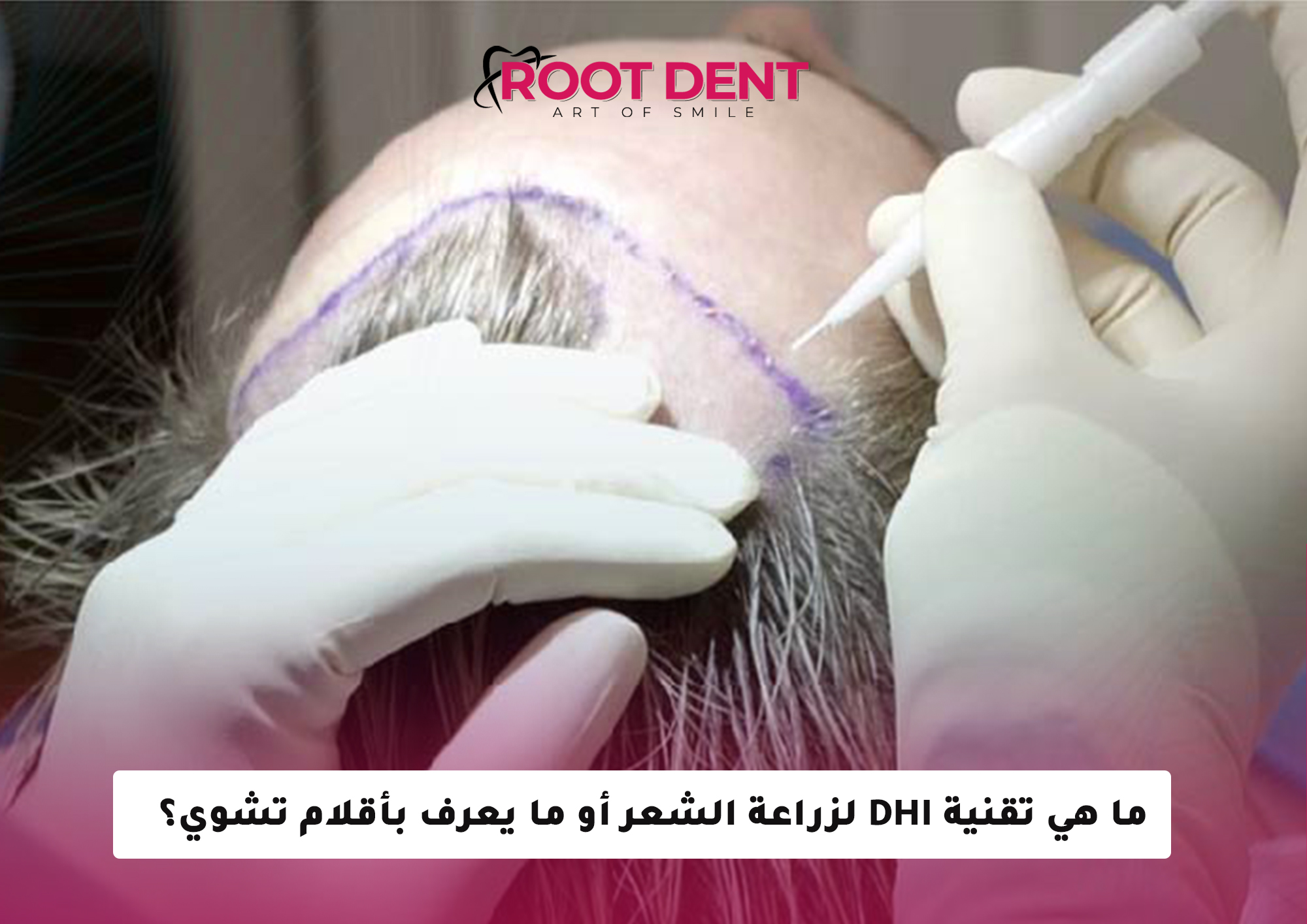 ما هي تقنية DHI لزراعة الشعر أو ما يعرف بأقلام تشوي؟