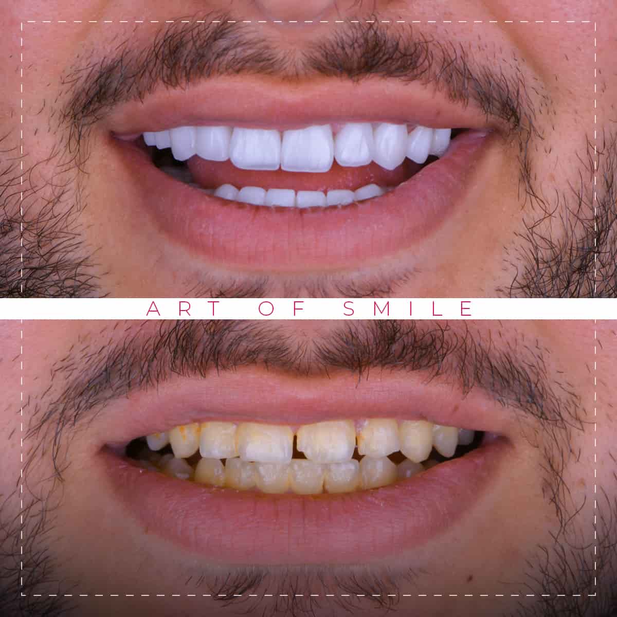 Ästhetische Zahnheilkunde vorher und nachher, Zahnreinigung, Hollywood-Lächeln, Zahnimplantate