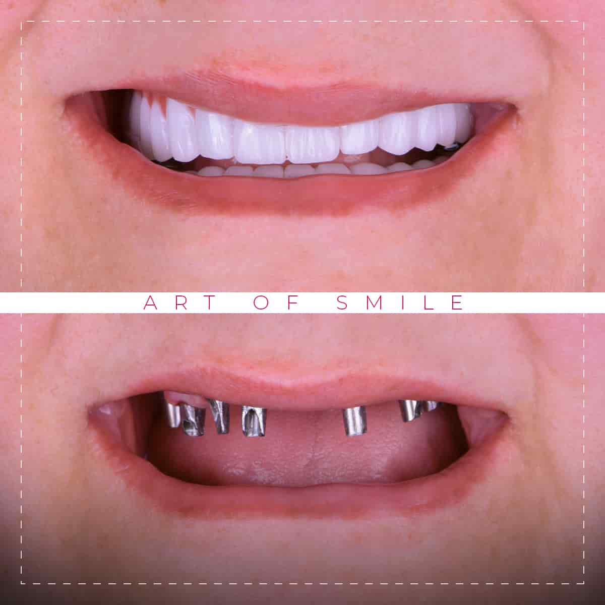 Ästhetische Zahnheilkunde vorher und nachher, Zahnreinigung, Hollywood-Lächeln, Zahnimplantate