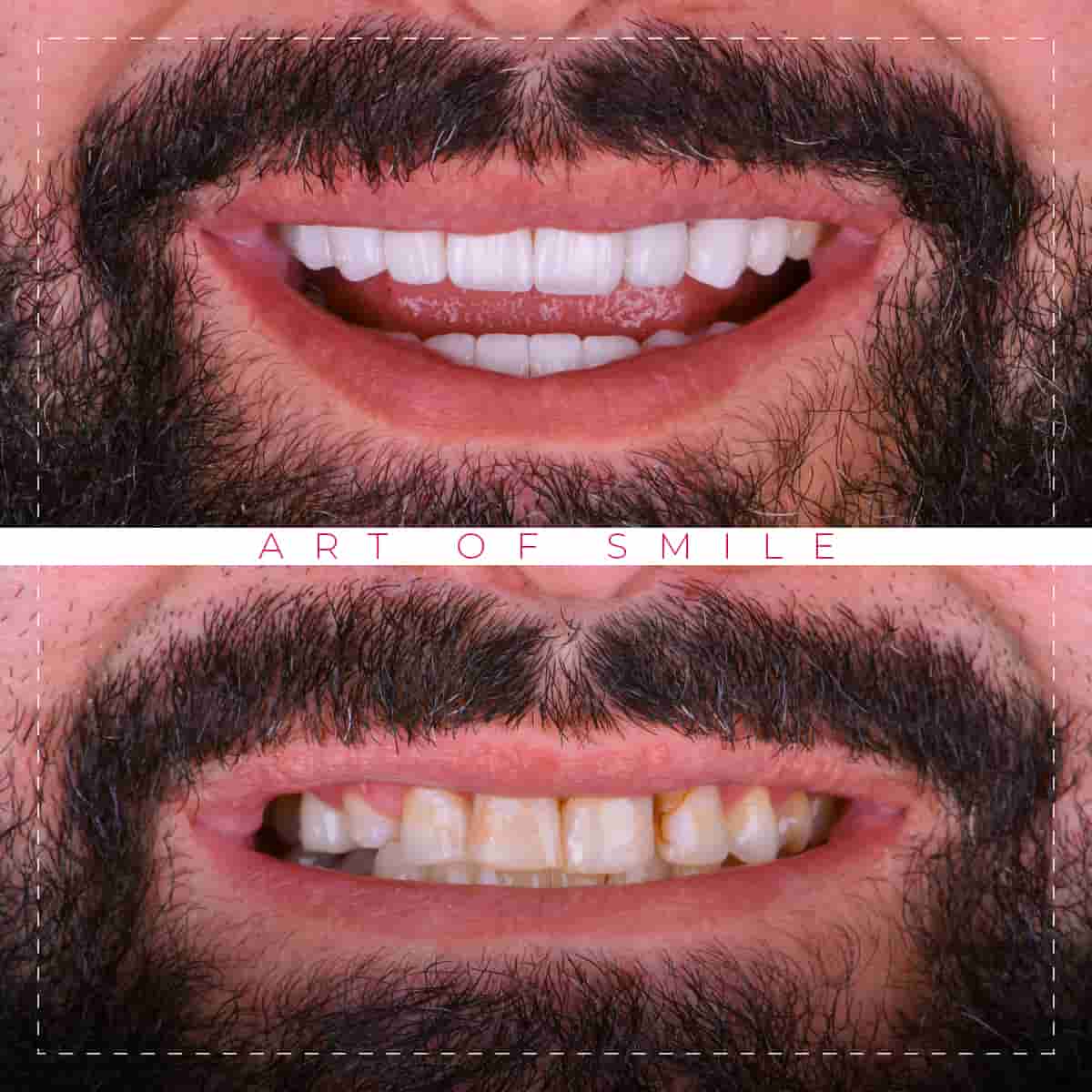 تجميل الاسنان قبل وبعد, تنظيف الاسنان, ابتسامة هوليود, زراعة اسنان