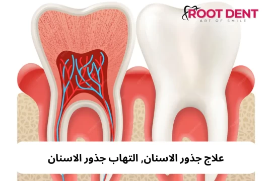 التهاب جذور الاسنان, علاج جذور الأسنان المتعفنة