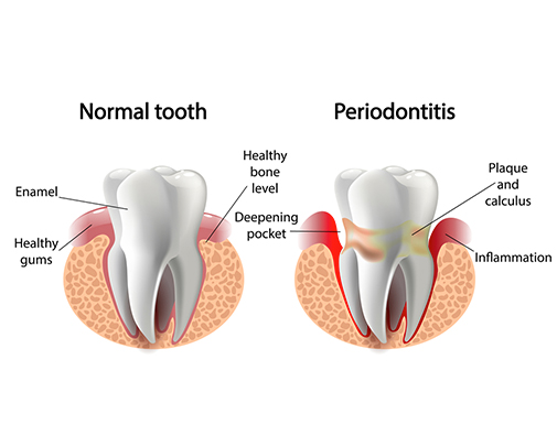 Advanced periodontal treatment