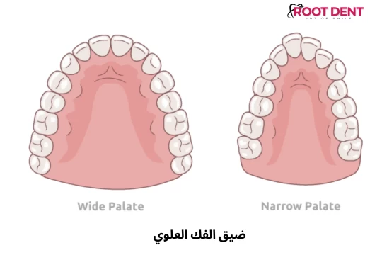 ضيق الفك العلوي, الاسباب وطرق العلاج