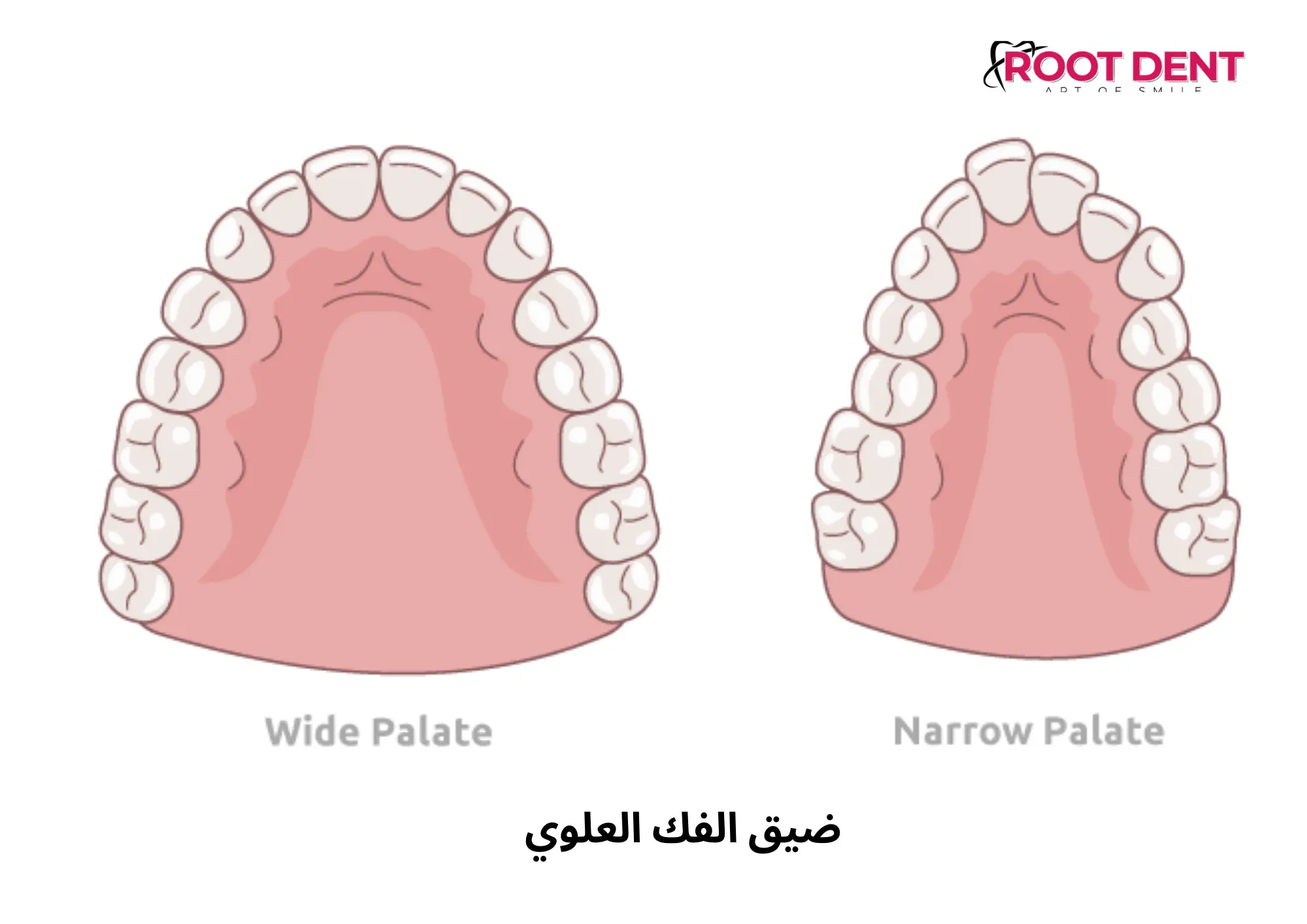 ضيق الفك العلوي, الاسباب وطرق العلاج