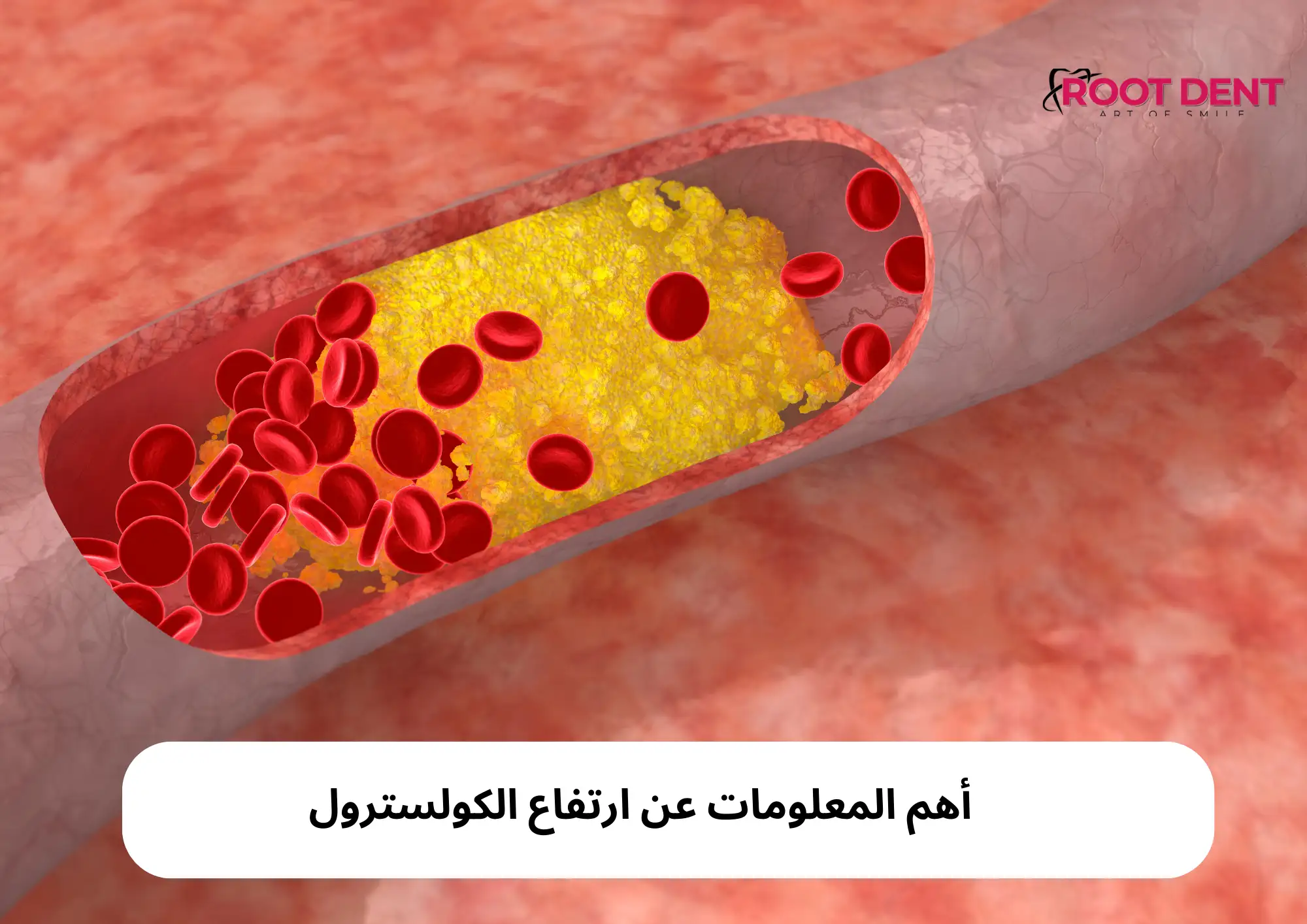 أهم المعلومات عن ارتفاع الكولسترول