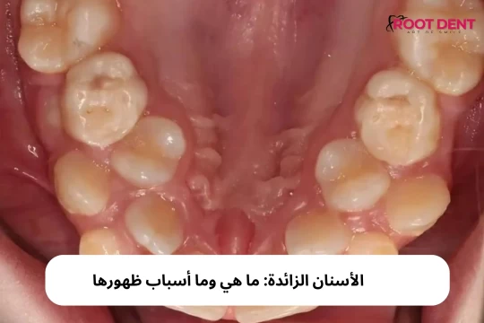 الأسنان الزائدة: ما هي وما أسباب ظهورها